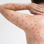 Mpox: o que é, como ocorre a transmissão e por que entender a doença é essencial para a prevenção