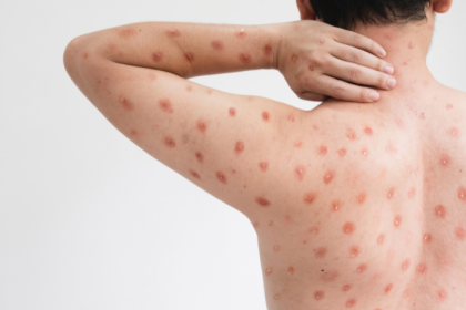 Mpox: o que é, como ocorre a transmissão e por que entender a doença é essencial para a prevenção